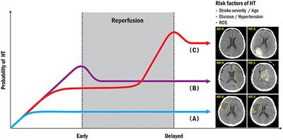 Hemorrhagic Transformation After Ischemic Stroke: Mechanisms and Management